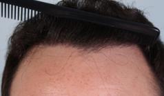 Before Hair Transplant&nbsp;Front